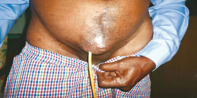 Prostate health awareness